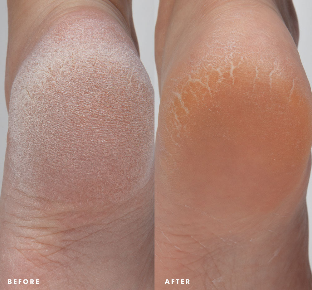 Enrich Mint® Foot Rescue Mask